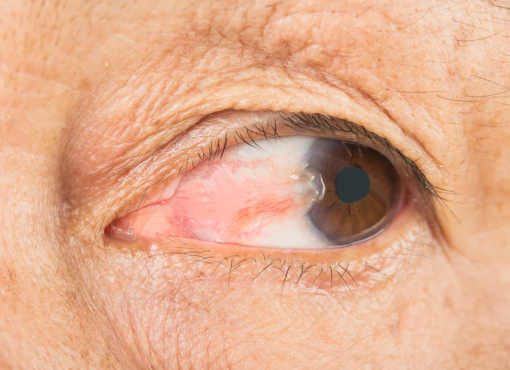 Pterygium